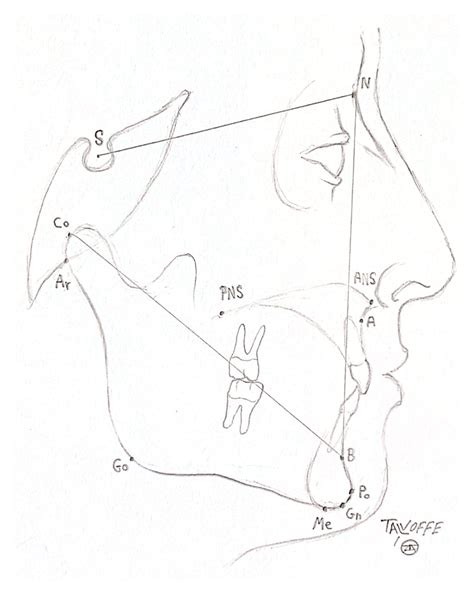 Impact and Stability of Mandibular Setback after Intraoral Vertical ...
