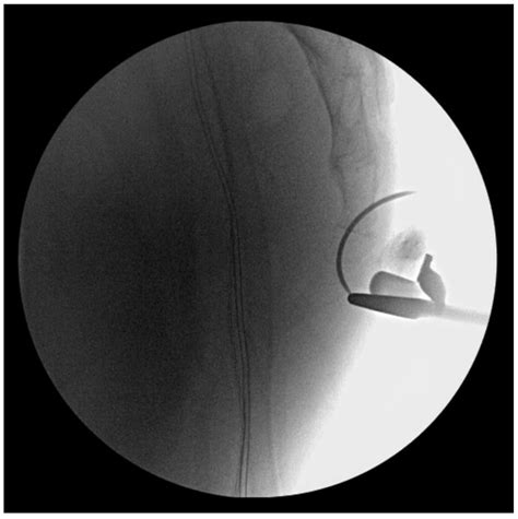 Minimally Invasive Open Reduction and Maintenance Technique for ...