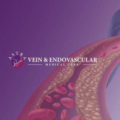 Advantages of Services in Astra Vein Treatment Center Tickets, Astra ...