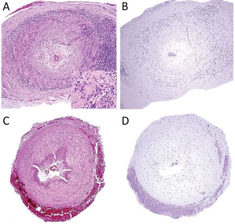 Investigating the Association of Giant Cell Arteritis with Varicella Zoster Virus in Temporal ...