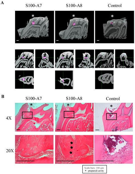 Protein S100-A7 Derived from Digested Dentin Is a Critical Molecule for ...
