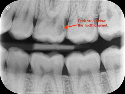 Importance of Dental X-rays