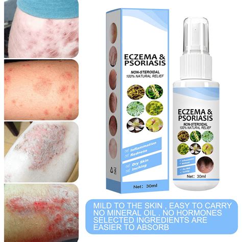 Anti Itch Spray & Antiseptic, Bacteriostatic Spray Body Itch Psoriasis ...