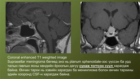 Pituitary gland MRI | PPTX