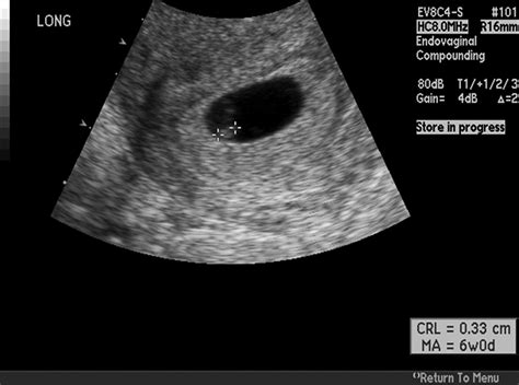 6 Week Ultrasound Heartbeat