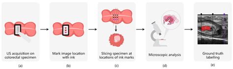 Tumor Segmentation in Colorectal Ultrasound Images Using an Ensemble ...