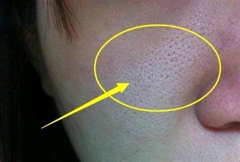 【图】男生嘴巴周围长痘痘是什么原因 6个方法帮你轻松祛痘(3)_伊秀美容网|yxlady.com