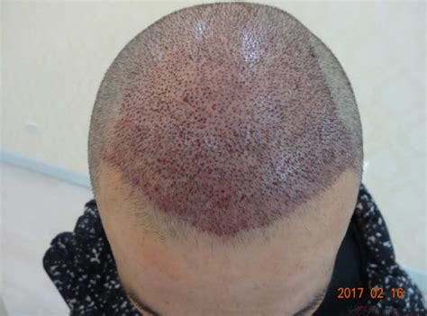 男性脱发是什么样子的_脱发_北京京城皮肤医院(北京医保定点机构)