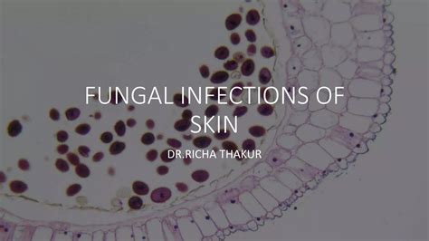 Fungal infections of skin | PPTX