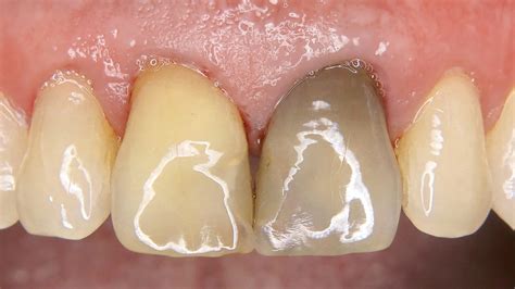 Endodontisch bedingte Zahnverfärbungen | Quintessenz Verlags-GmbH