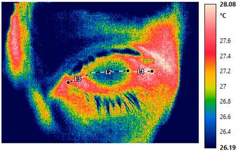 Ocular Surface Temperature Profile of Eyes with Retinal Vein Occlusion