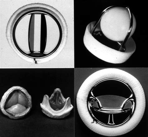 Choice of heart valve prosthesis | Heart