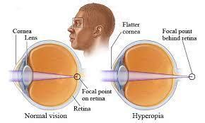 difference between the near vision and distant vision ( Shape of the ...