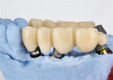 Dental Implants | Beauty Brace Dental Clinic Johor Bahru