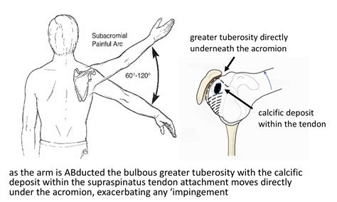 Calcific Tendonitis - Cambridge Shoulder