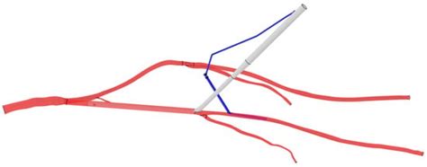 Preventing Acute Limb Ischemia during VA-ECMO—In Silico Analysis of ...