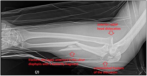 Anterior Radial Head Dislocation Associated with a Bifocal Fracture of ...