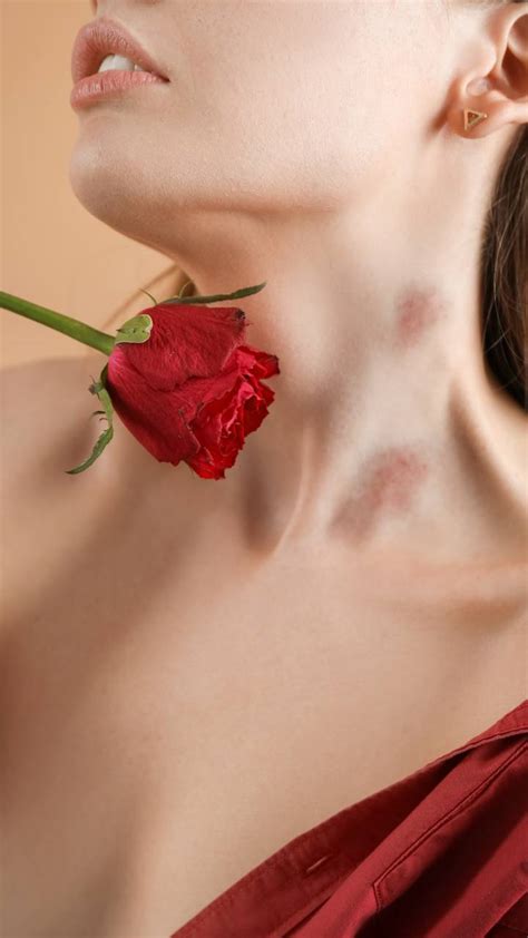 Know How To Get Rid of a Hickey At Home
