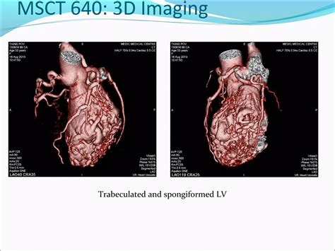 Noncompaction Cardiomyopathy, NGUYEN TUAN VU, NGUYEN THI KIM SANG, DUONG PHI SON, PHAN THANH HAI ...