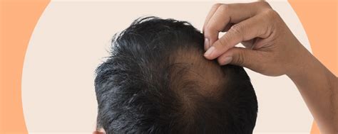 The Ultimate Guide to Bald Hair Shampoo and Scalp Care.