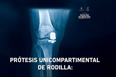 Prótesis unicompartimental: guía para un reemplazo de rodilla eficaz