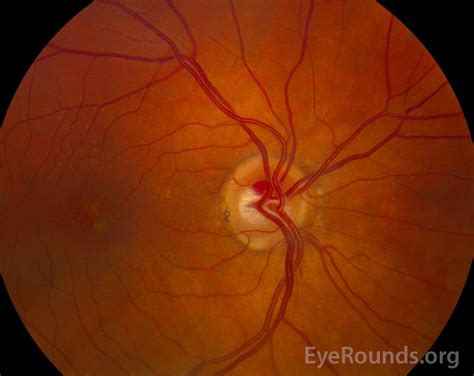 Atlas Entry - Intrapapillary Hemorrhage