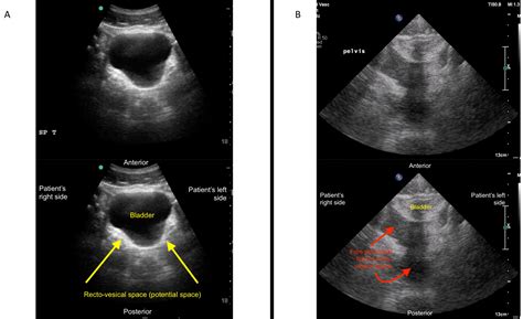Focused Assessment with Sonography for Trauma (FAST) Exam: Image ...