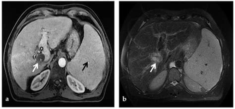The Role of Imaging in Portal Vein Thrombosis: From the Diagnosis to ...