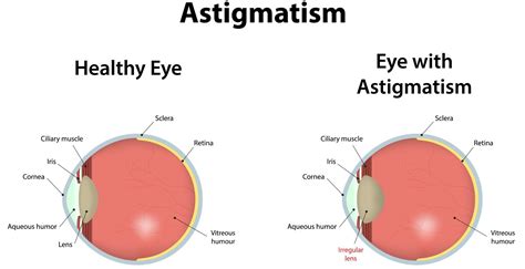 What is Astigmatism and what causes it? | SmartBuyGlasses CA