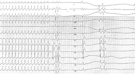 Narrow QRS Tachycardia – Cardio Guide - adenosine for svt