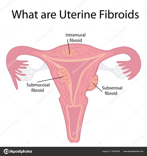 Types of Uterine Fibroids — Stock Vector © crazy.photoshoper2015.yandex.ua #178830426