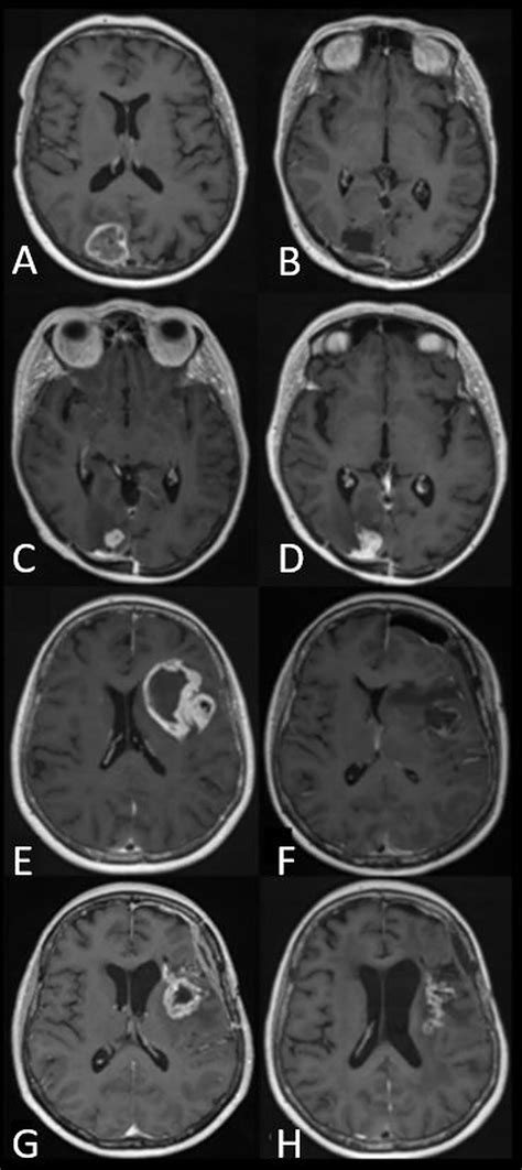 Frontiers | High-Grade Glioma Treatment Response Monitoring Biomarkers: A Position Statement on ...