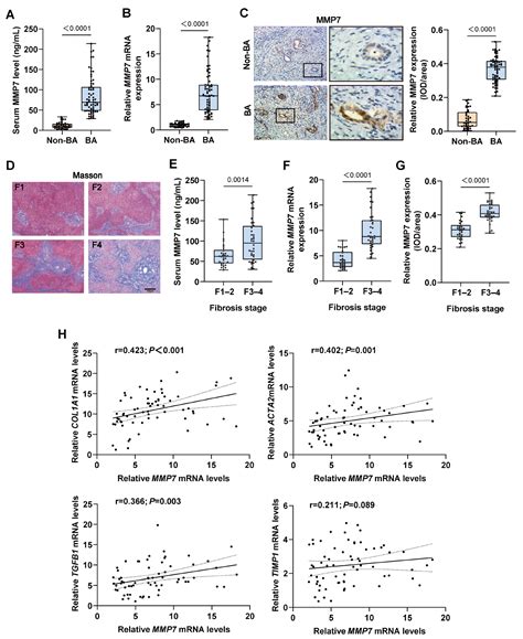 Matrix Metalloproteinase 7 Mediates Epithelial–Mesenchymal Transition ...