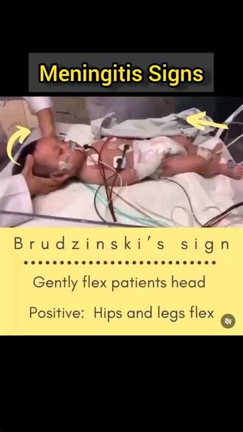 Kernigs Sign Meningitis Tests | Brudzinski's & Kernig's Signs