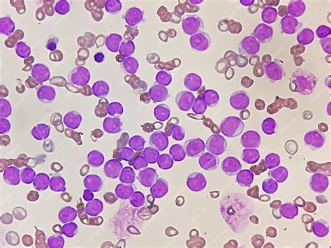 Leucemia Linfoblastica Aguda