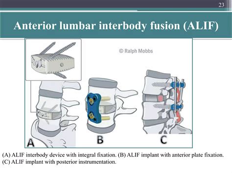 Lumbar interbody fusion indications techniques and complications | PPTX
