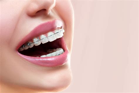 Dental Braces for Teeth Singapore - Dental Essence