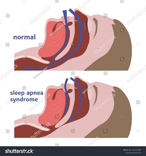 Image result for Sleep Apnea Example