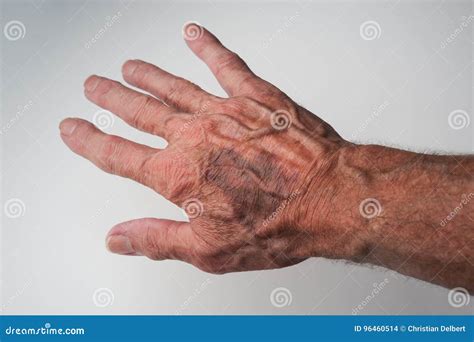 Bruises and Blood Spots Under the Skin that Occur on Older People Stock ...