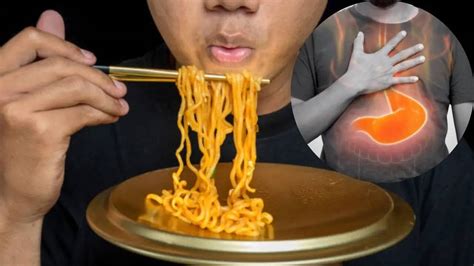 Buldak Noodles Side Effects: GERD, Ulcers and Gut Risks | Times Now