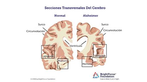 Diagrama Transversal Do Cerebro
