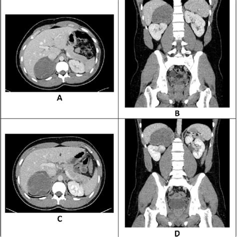 Image result for CT Scan with Contrast