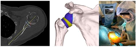 Computer-Assisted Navigation in Reverse Shoulder Arthroplasty: Surgical ...