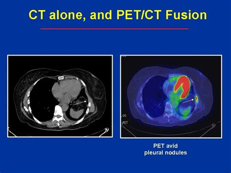 Image result for PET/CT Scan Risks