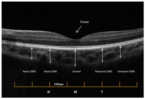 JPM | Special Issue : Clinical and Translational Research in Ophthalmology