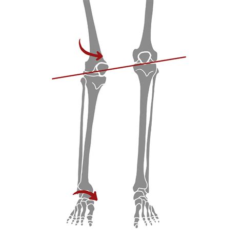 How to Correct Overpronation Using the Pelvic Clock® Exercise Device — Pelvic Clock® Exercise Device