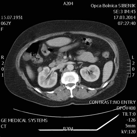Image result for Hal Nephrectomy