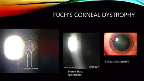 CORNEAL DYSTROPHIES | PPT