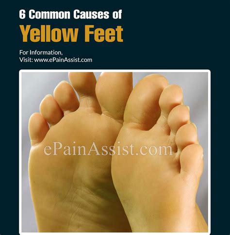 6 Common Causes of Yellow Feet & Its Diagnosis