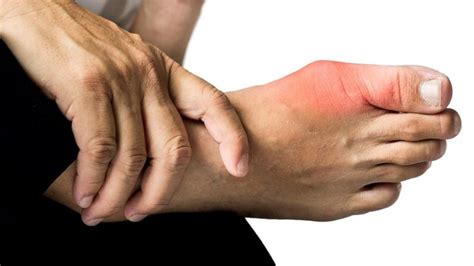 What is Gouty Arthritis: Progression, Stages, Symptoms, Diagnosis and ...